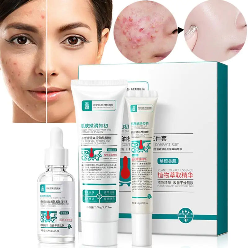 Anti Acne Removal Moisturizing Face Skin Care Kit